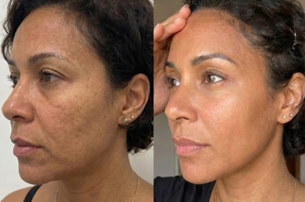 Reduced Blemishes & Fine Lines
