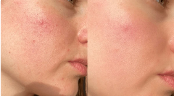 Blemishes, Redness
