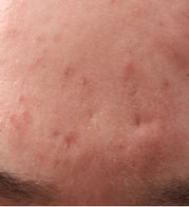 Brighter, Clearer, Radiant Skin - Before
