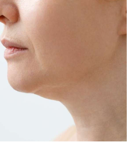 Lifted, Firmer-Looking Skin - Before