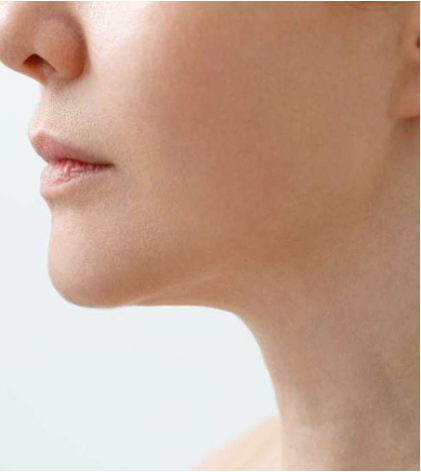 Lifted, Firmer-Looking Skin - After