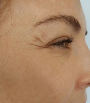 Up to 99% Reduction in Wrinkles & Fine Lines - Before
