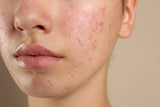 Acne