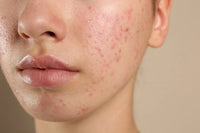 Acne