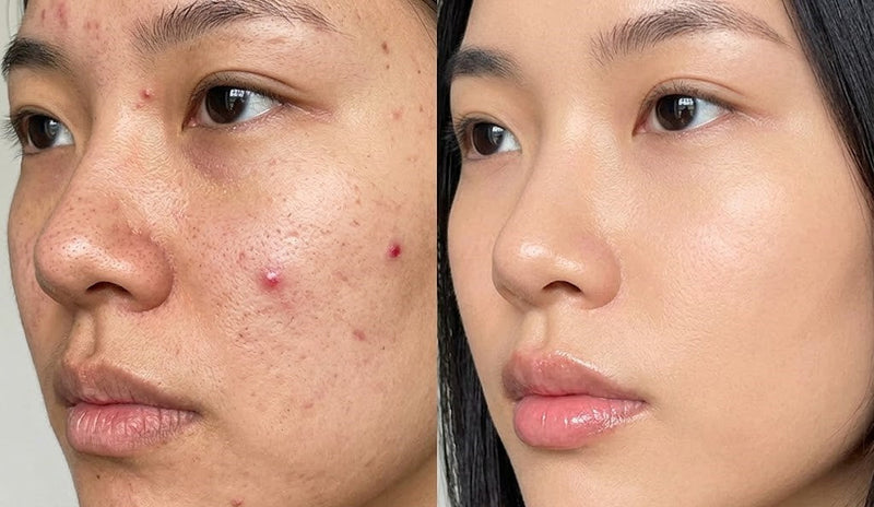 Acne, Scars