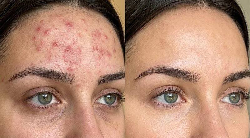 Acne, Enlarged Pores